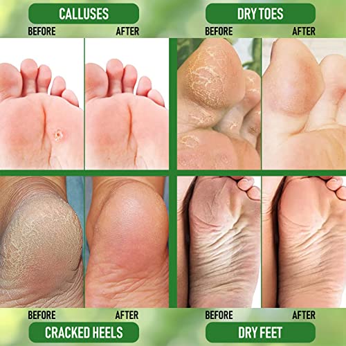 Urea 40% Cream – Made in USA – Foot Cream for Thick, Cracked, Rough, Dead & Dry Skin - Corn, Callus and Dead Skin Remover, Toenail Softener, Moisturizer For Feet, Elbows, Hands and Knees
